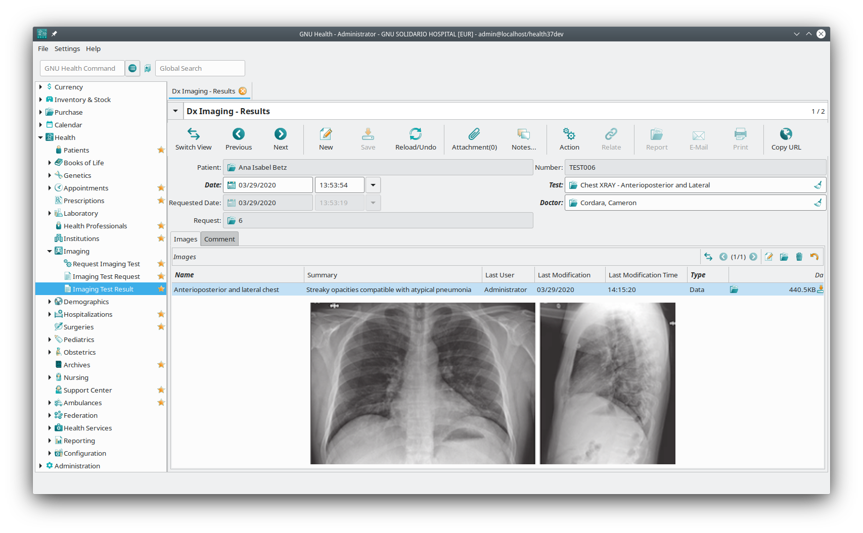 gnuhealth-dx-imaging-atypical_pneumonia_covid19